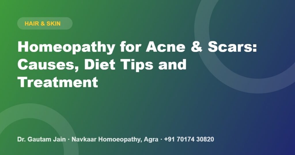 Homeopathy for Acne & Scars: Causes, Diet Tips and Treatment